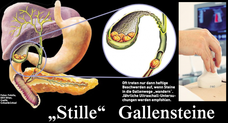 Gallensteine, Gallenblasenentzündung Symptome, Ursachen, Operation